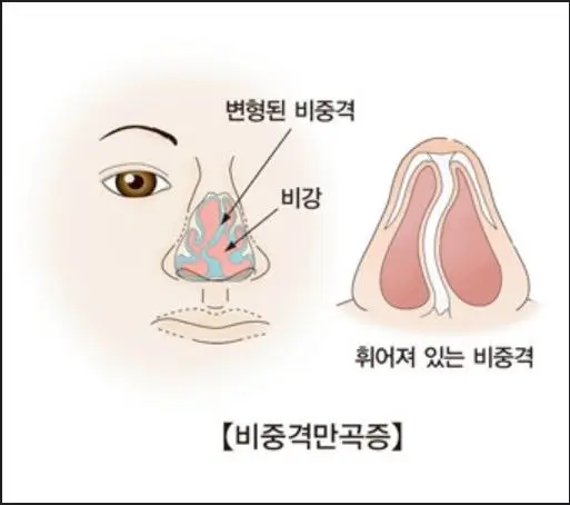 비중격 만곡증(출처 다음백과)