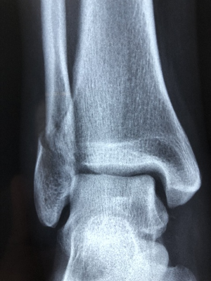 뼈끼리 만나는 관절부분의 엑스레이사진