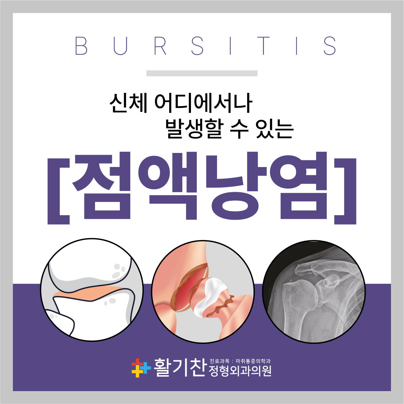  연신내역정형외과, 무릎 염증때문에 통증 생겼다면?