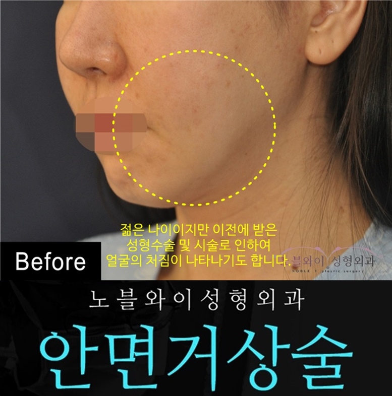  스마스안면거상술 후회없게끔