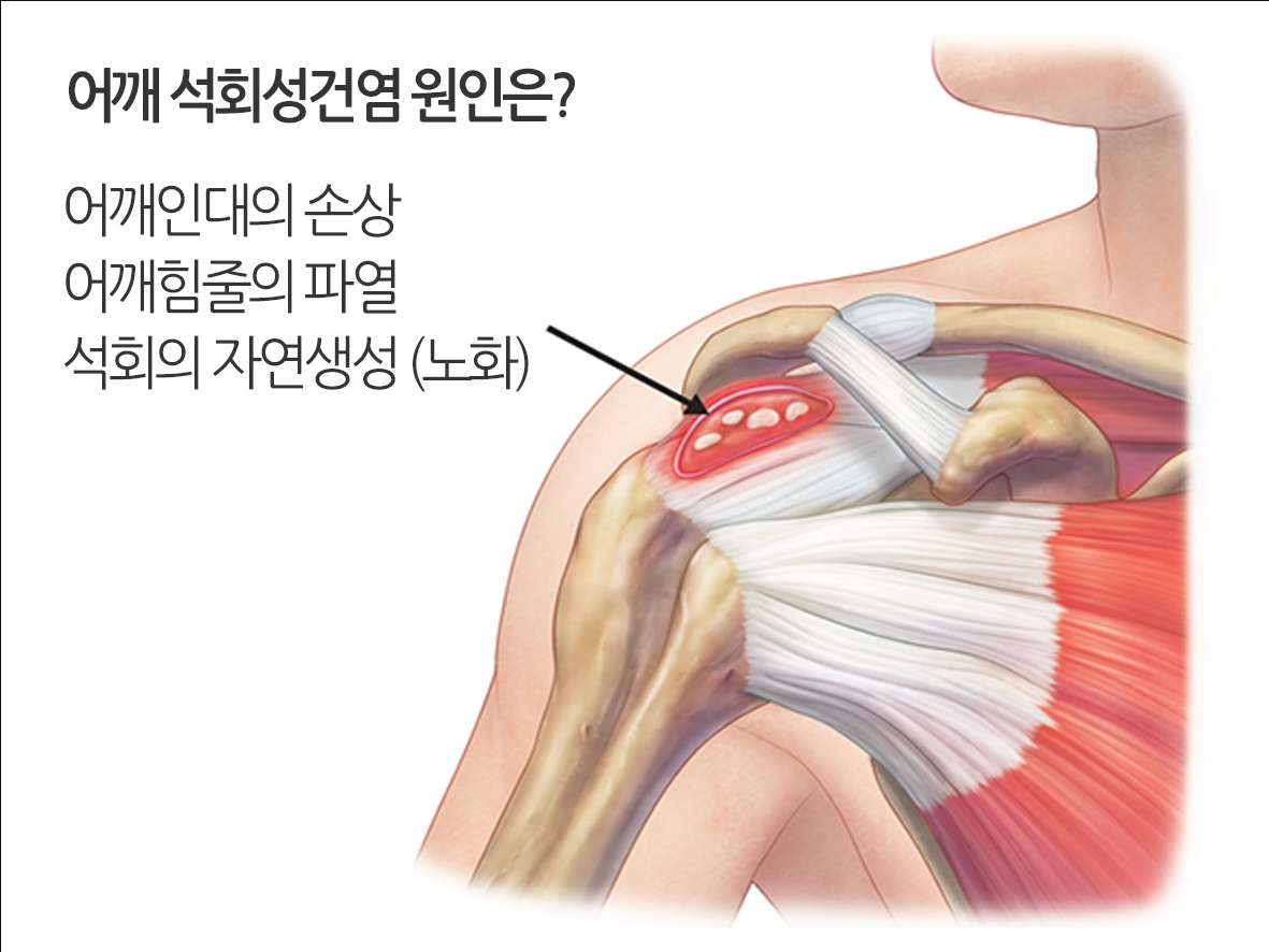  어깨통증원인 8초만에 잡는법