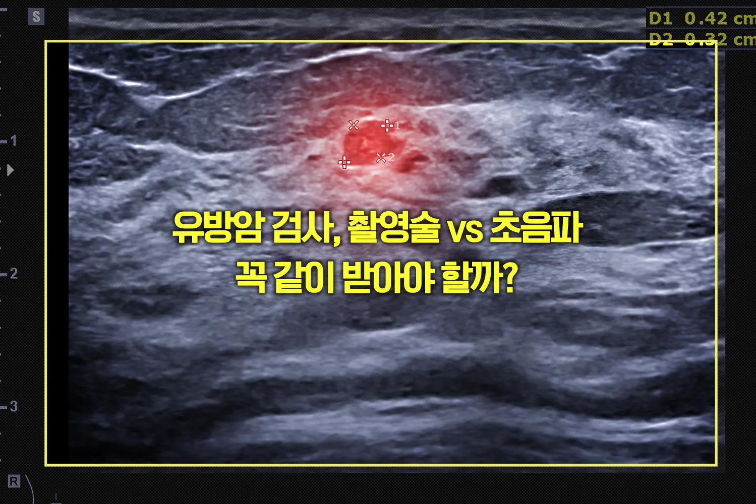 유방촬영술 유방초음파