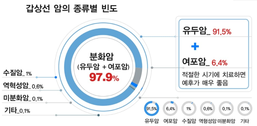 갑상선암-종류