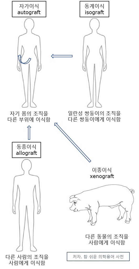 자가이식 동계이식 동종이식 이종이식의 차이