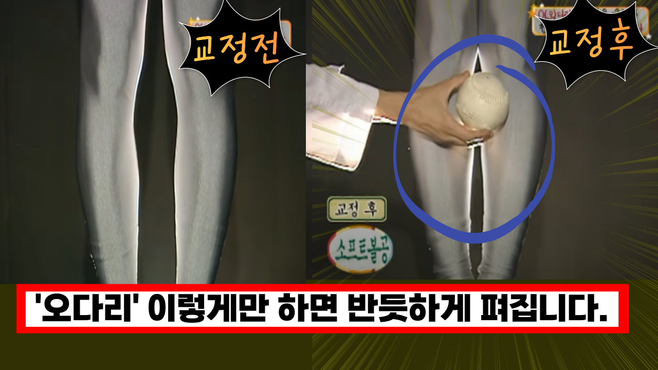  'O(오) 다리가 고민인 분이라면 집중' 오다리 이렇게만 하면 반듯하게 펴집니다.