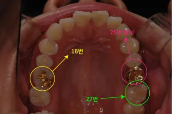 어금니 칫솔 사용법 선택방법 실사용 후기_17