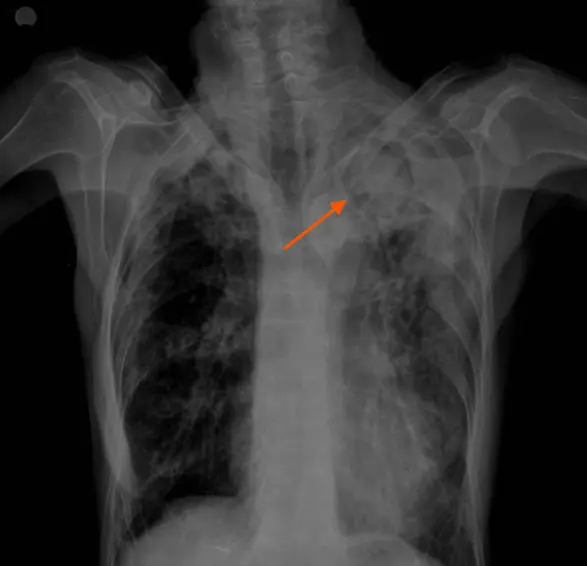 진균종의 chest Xray