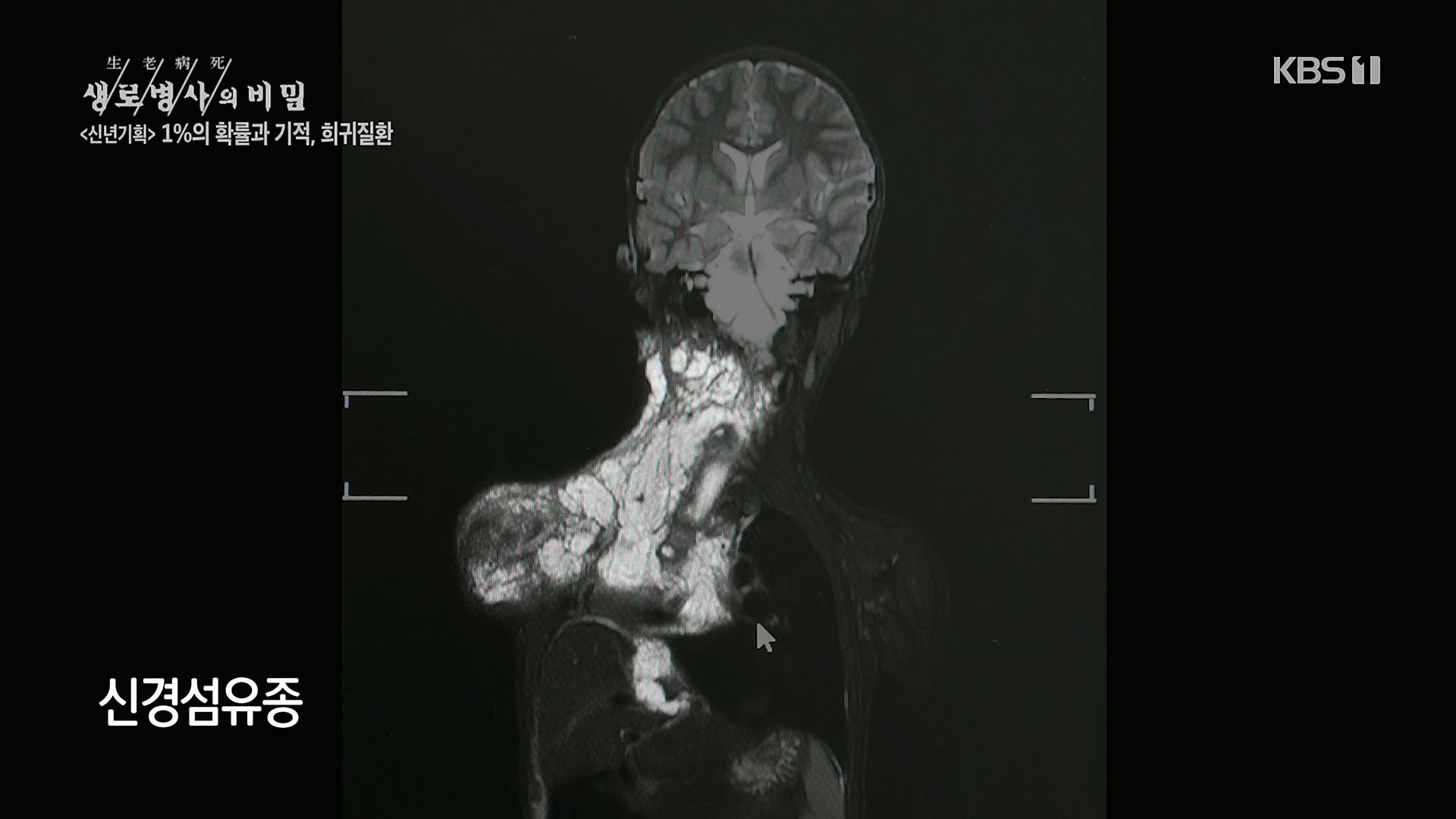 생로병사의 비밀.E850.230104p.H264-F1RST.mp4_20230117_195206.853.jpg