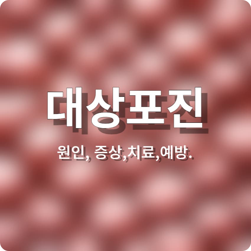 대상포진-원인&#44;증상&#44;치료&#44;예방