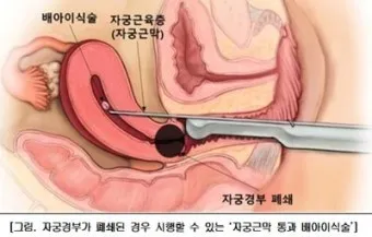 출산 후 자궁수축 기간_2