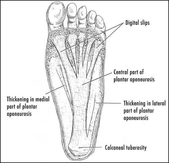 발바닥 근막을 나타낸 그림으로 내측과 외측 그리고 중앙부위로 나뉘어진 그림