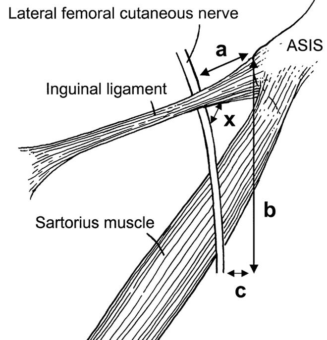 외측대퇴피신경이 서혜인대를 지나갈 때 신경이 지나가는 지점을 나타내는 그림