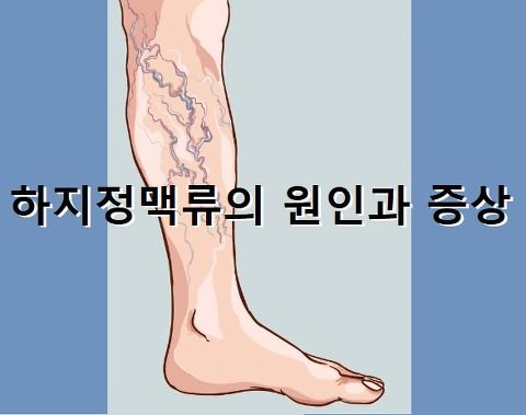 하지 정맥류 증상&amp;#44; 원인