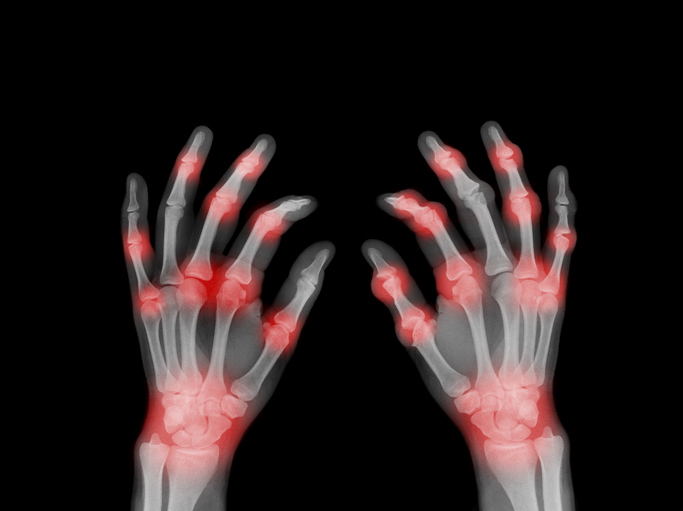 류마티스관절염은 손가락 전체에 통증이 자주 나타난다.