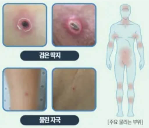 진드기-물린-후-증상