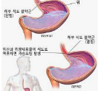 역류성 식도염의 원인과 증상