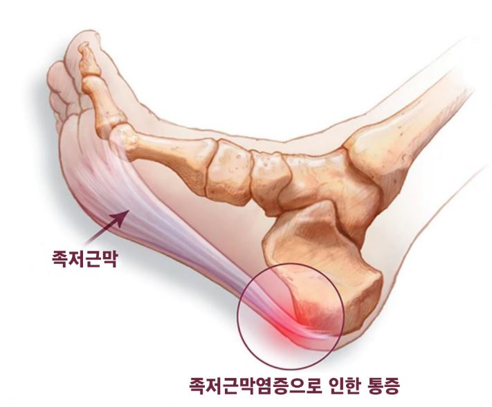 족저근막염