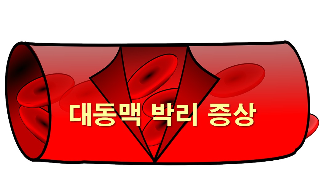  대동맥 박리 증상과 대동맥 박리 원인