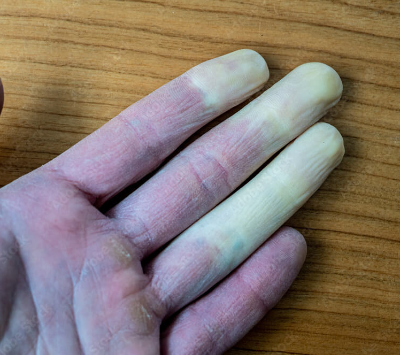 레이노 증후군은 네 번째 손가락이 하얗고 파랗게 변합니다.