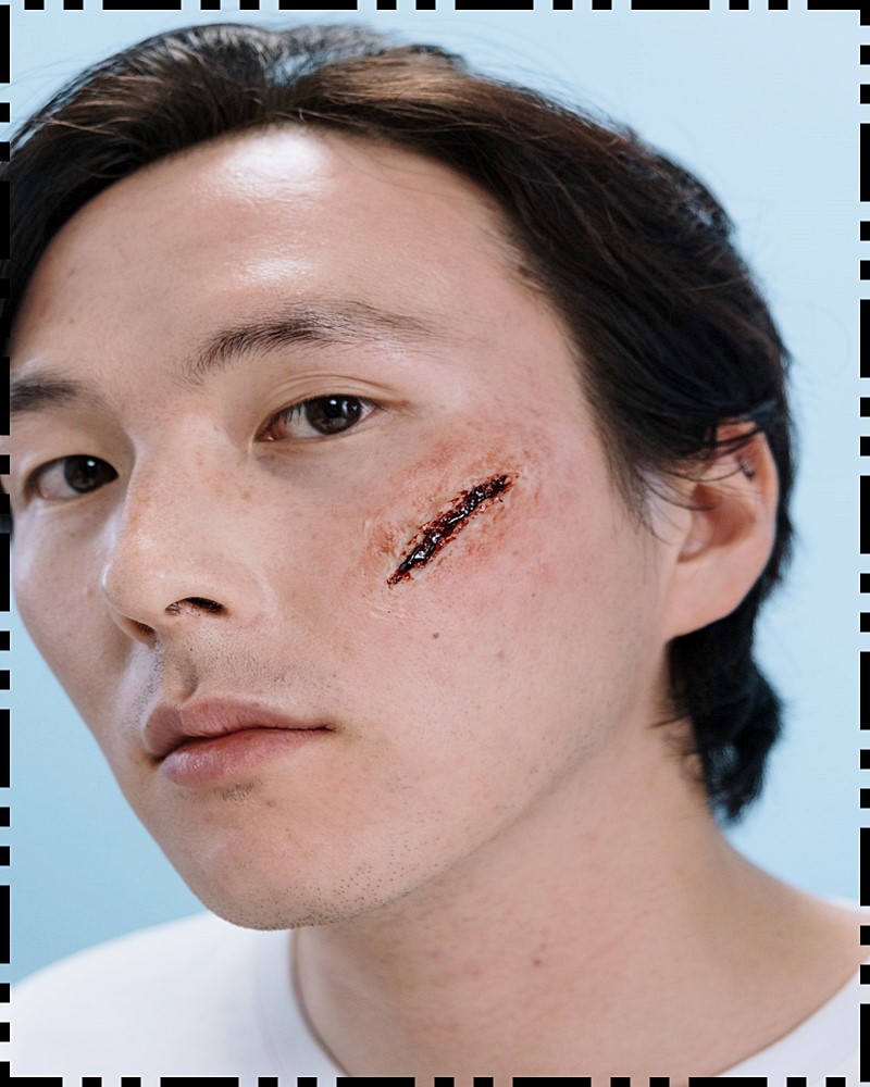  수술후, 콤플레스를 만드는 흉터 치료가 중요하다.