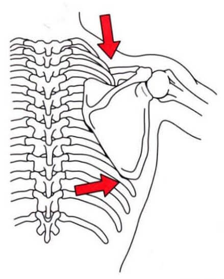 승모근을 담당하는 척추부신경의 문제로 견갑골의 하강과 외회전이 일어나는 그림