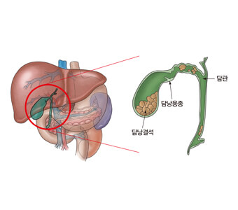 담낭용종-수술방법-수술비용