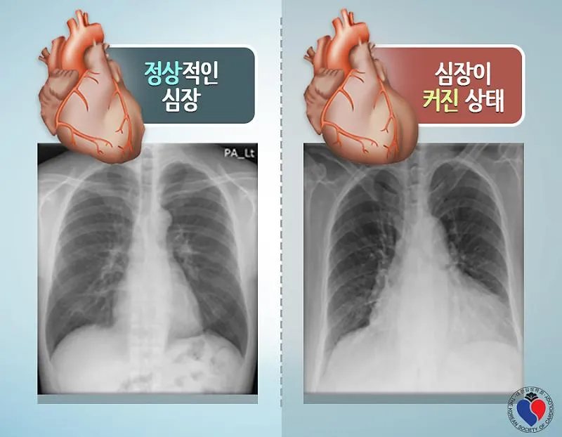 가슴이 두근두근 뛰고 답답할때_8