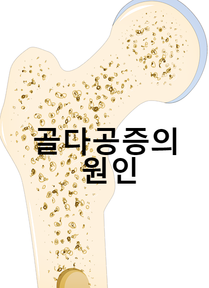  골다공증의 원인 8가지