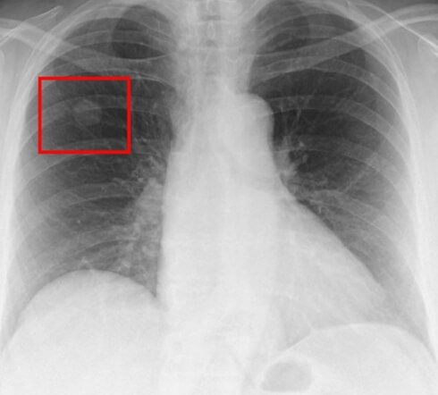 건강 검진 흉부 엑스레이 폐결절 사진