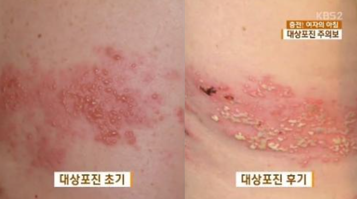 대상포진-초기와-후기-물집