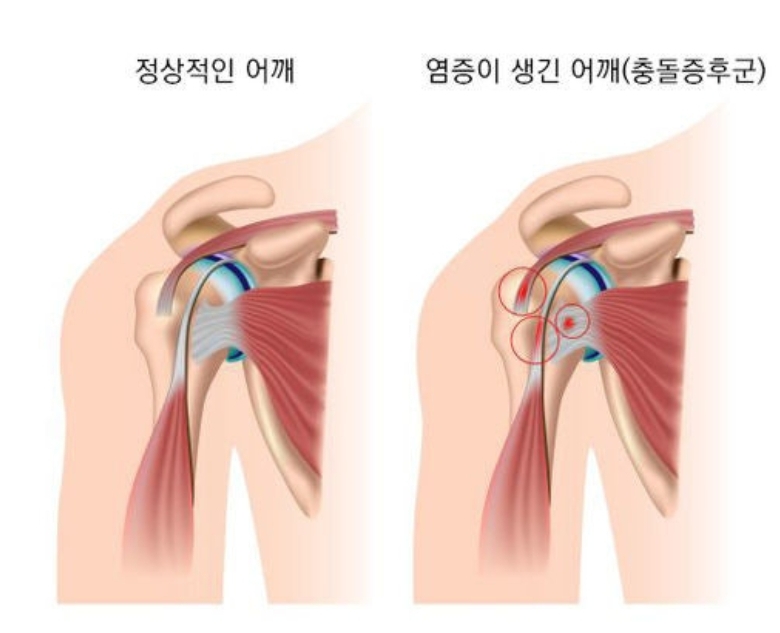 어깨충돌증후군 이미지