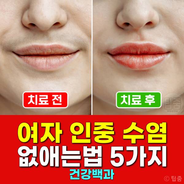 여자 인중 수염 없애는법 제모 없이 여자턱수염