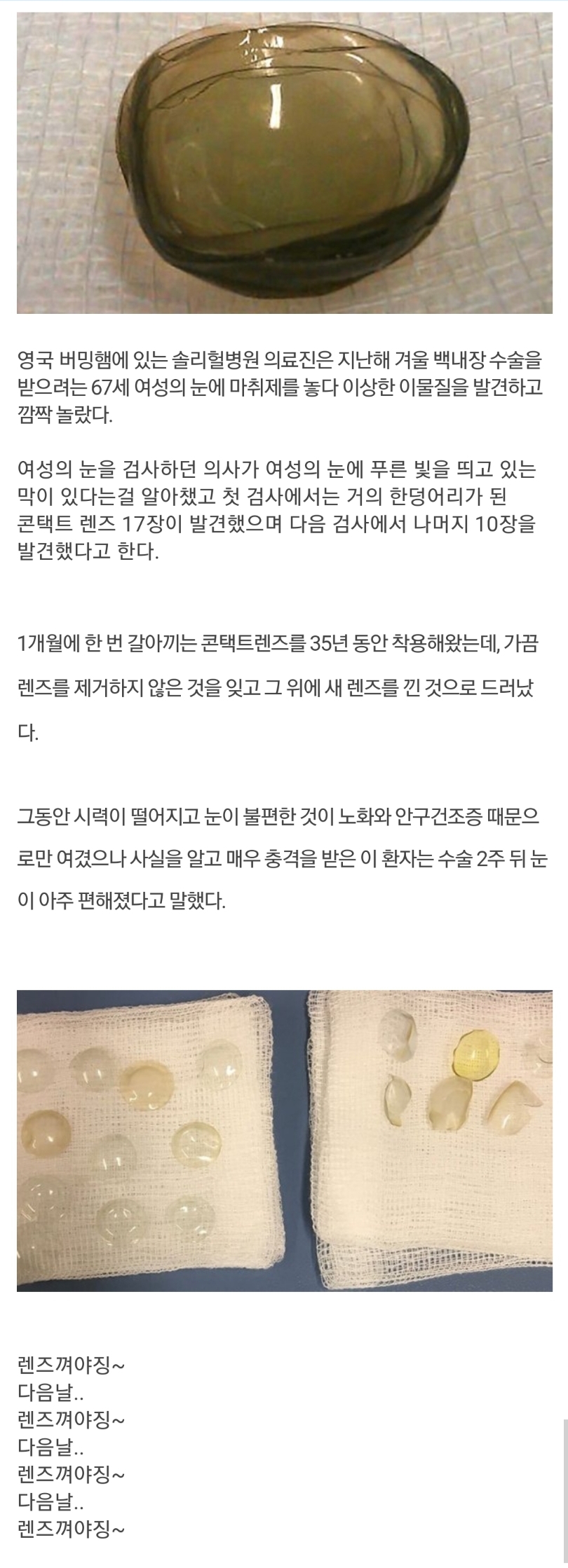  렌즈 빼는것 깜빡하면 안되는 이유