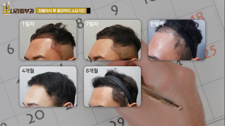 모발이식부작용 없는 성공 여부 판단 시기는