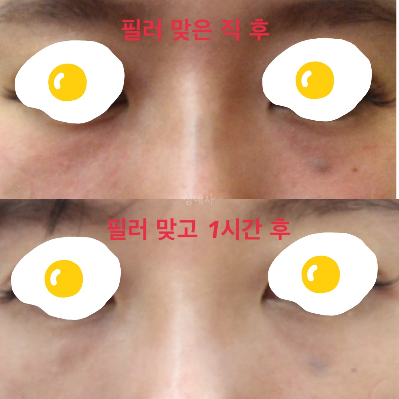 눈밑필러 후기