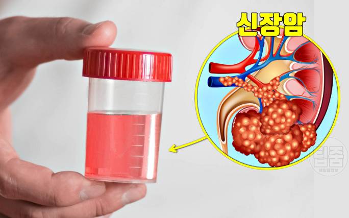 암 초기증상,신장암 증상