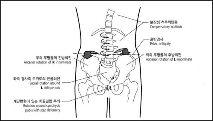 골반의 틀어짐을 나타낸 그림으로 우측은 전방회전&#44; 좌측은 후방회전 된 그림