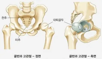 고관절 통증 증상 확인하기_7