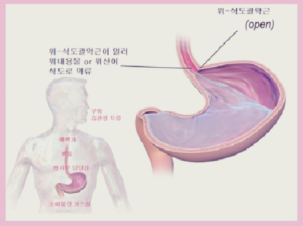  역류성 식도염 원인 증상 예방 치료까지 총정리