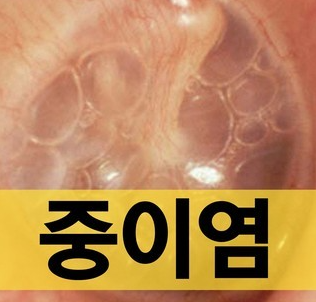  귀에서 고름이!? 만성 중이염