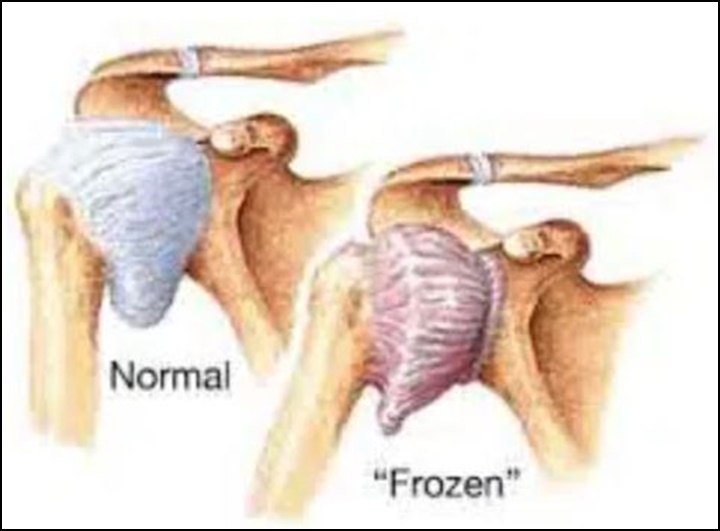 관절의 저가동성을 표현하기 위해서 어깨 관절에 유착성관절낭염 사진을 넣음.