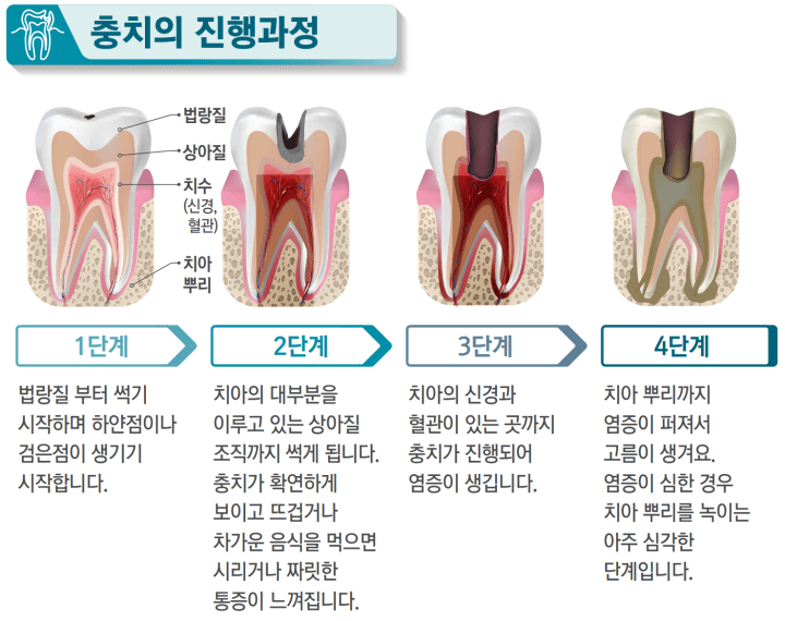 충치의 진행과정