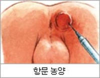 치루수술 후기 #1. 항문농양이 생기다...