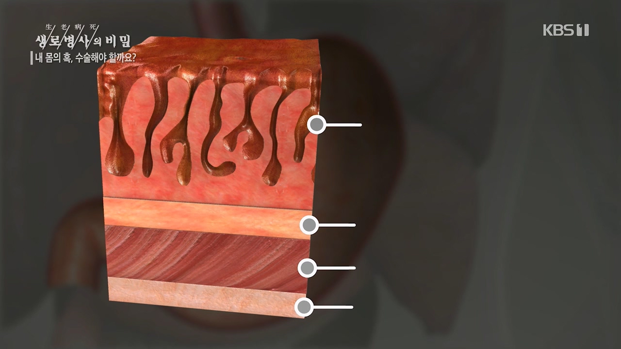 생로병사의 비밀.E870.230532p.H264-F1RST.mp4_20230605_201515.024.jpg