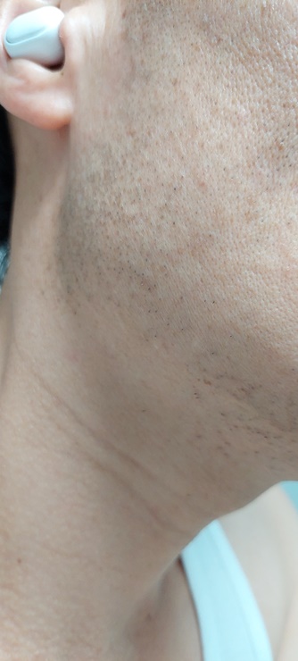 2일후 브라운7로 귀밑 면도한 모습