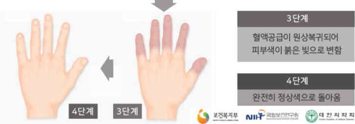 레이노증후군과-손
