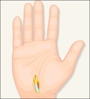 손목터널증후군 증상 -9