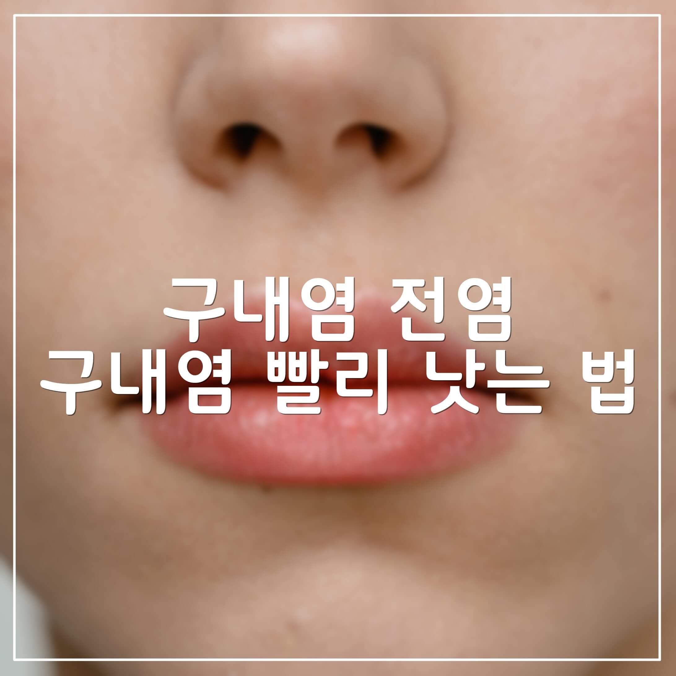  구내염 전염과 구내염 빨리 낫는 법
