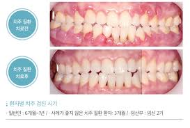 당뇨 환자는 왜 더 신경 써야 할까?-치주질환 