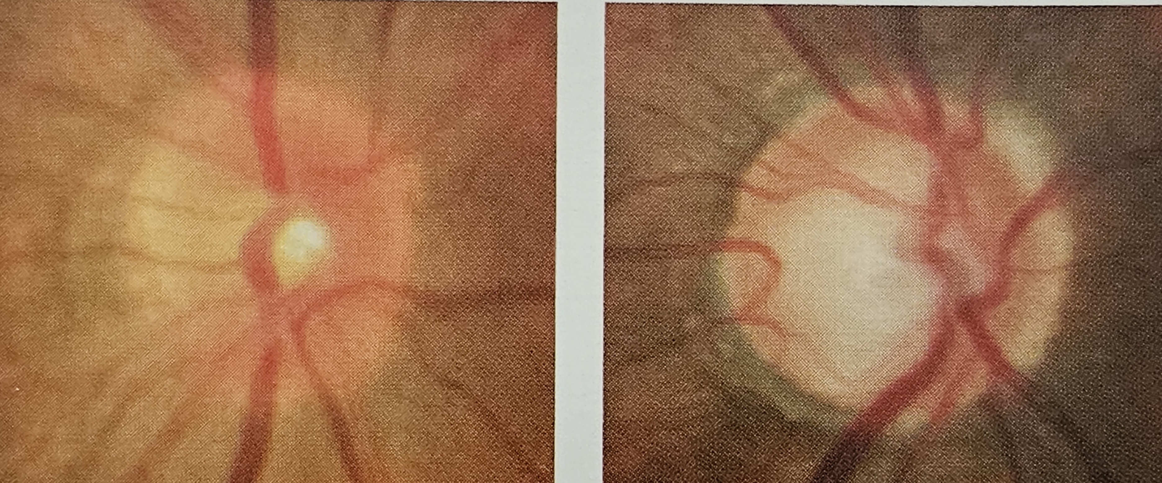 정상인의 시신경 모양(좌) 녹내장 환자의 시신경 모양(우)